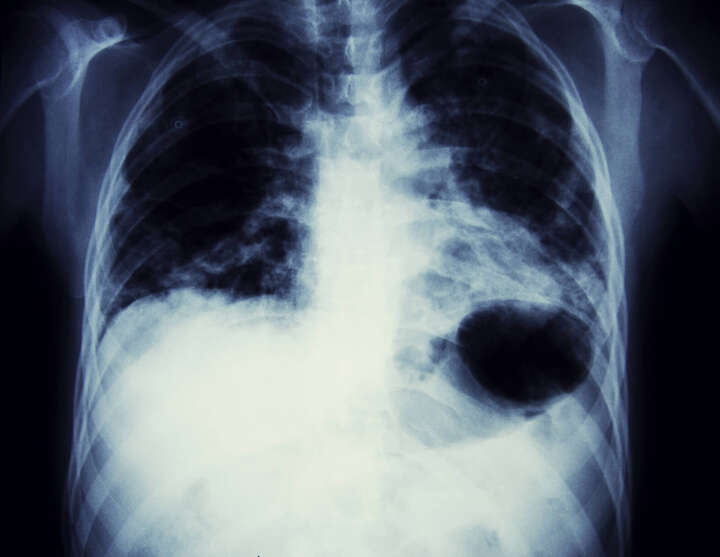 cáncer