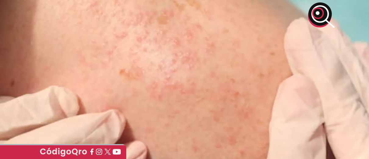 Suman 22 casos de sarampión en Querétaro