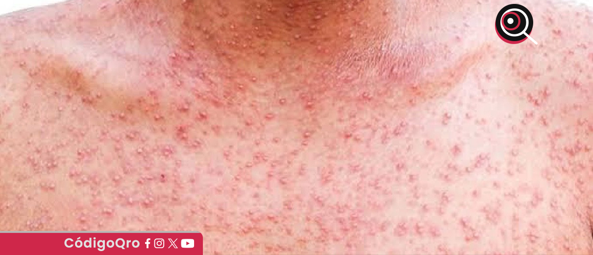 Suman 40 casos confirmados de sarampión en Querétaro