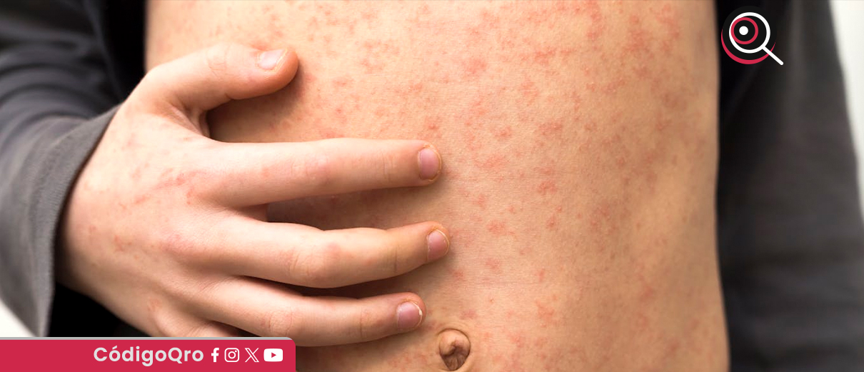 Suman 44 casos confirmados de sarampión en Querétaro