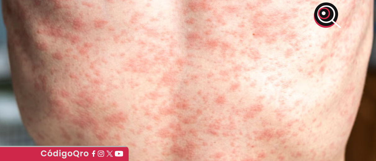 La Secretaría de Salud del Estado de Querétaro detectó 7 casos de sarampión en comunidad de Tequisquiapan