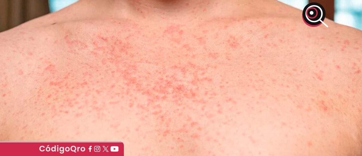 Suman 8 casos de sarampión en comunidad de Tequisquiapan