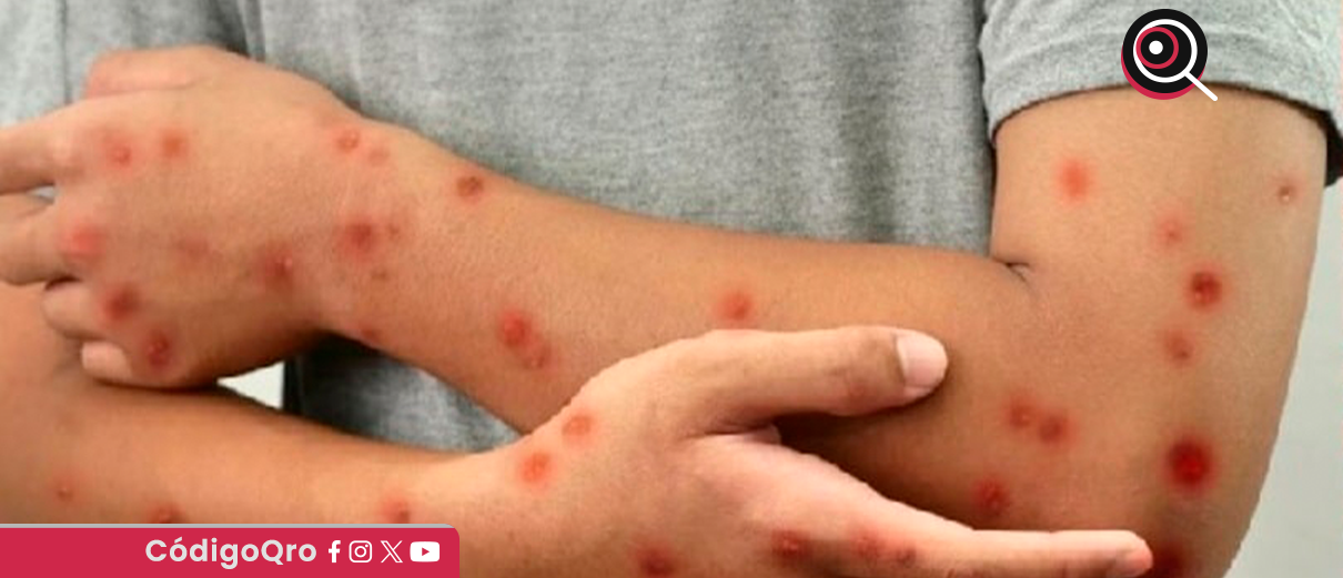 Canadá, pierde, estatus, libre, sarampión,