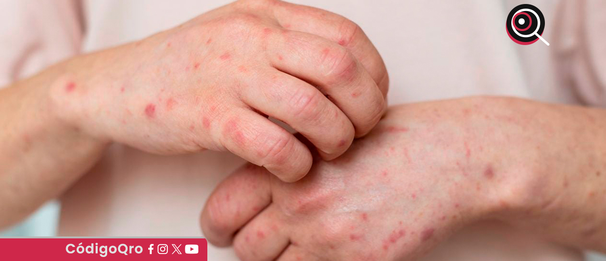 La Secretaría de Salud reportó más de 12 mil casos confirmados de sarampión en todo el país