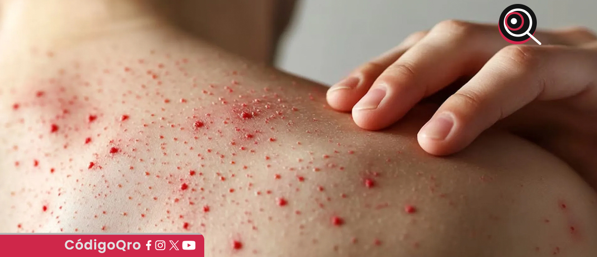 Reportan primera muerte por sarampión en Guerrero