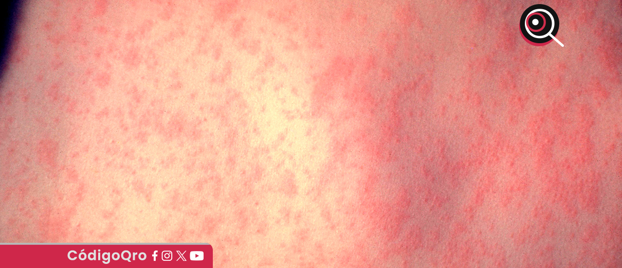 Suman 15 casos confirmados de sarampión en el estado de Querétaro