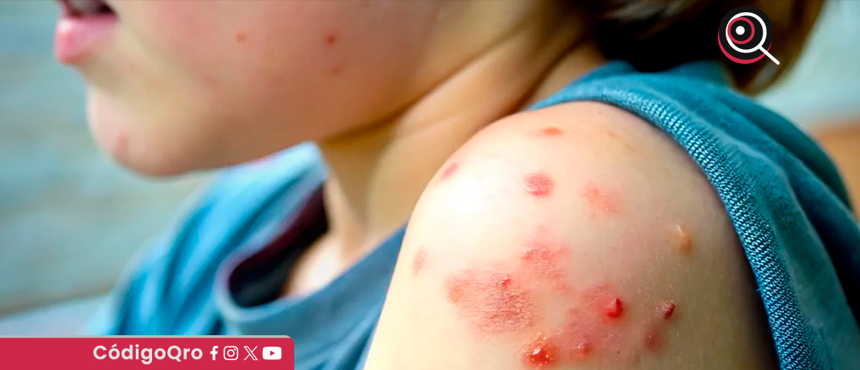 Suman 32 casos de sarampión en Querétaro