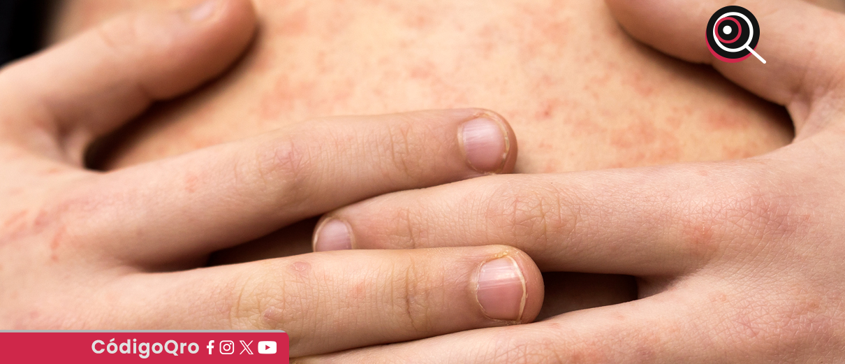 Quiénes deben vacunarse contra el sarampión