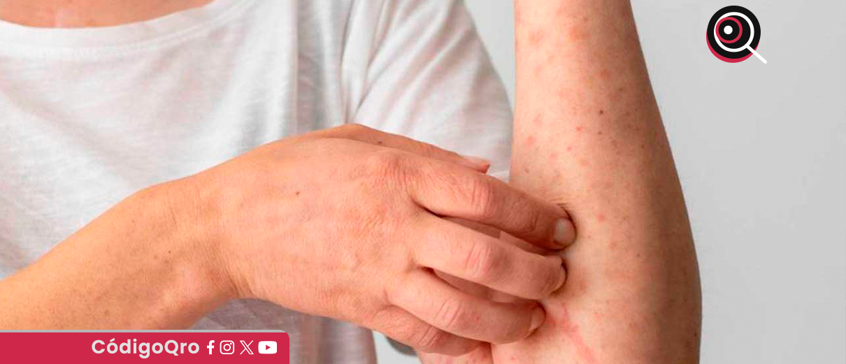 Suman siete casos confirmados de sarampión en Querétaro en 2026