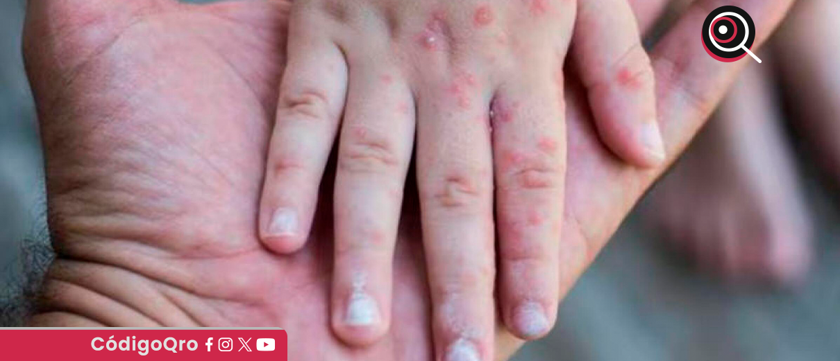 IMSS Querétaro invita a la población a acudir a vacunarse contra el sarampión