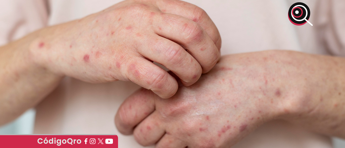 sarampión, San Joaquín,