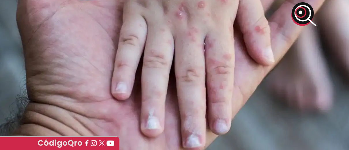 Sarampión: síntomas y complicaciones de la enfermedad