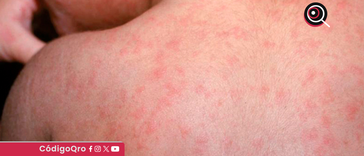 Suman 12 casos confirmados de sarampión en Querétaro