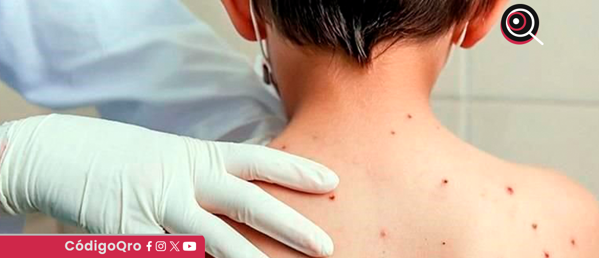 Salud reporta más de 8 mil casos y 27 defunciones por sarampión a un año del primer brote