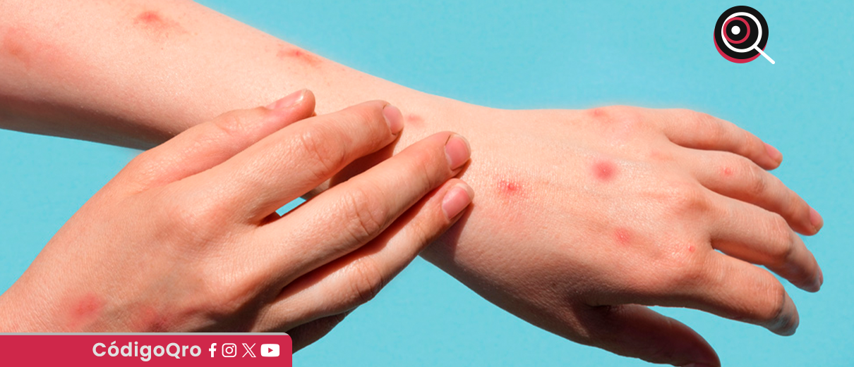 Detectan dos casos de sarampión en Cadereyta