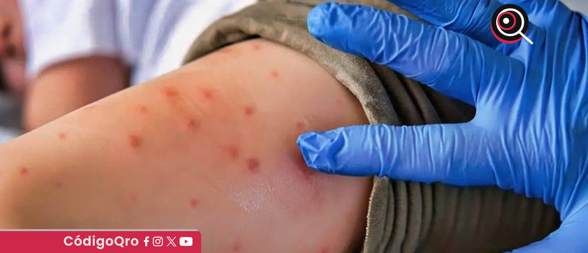 Confirman caso de sarampión en Querétaro; el acumulado estatal asciende a 41