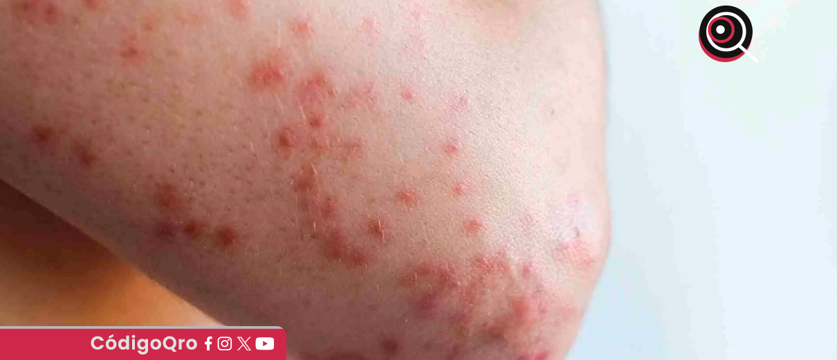 Suman 43 casos de sarampión en Querétaro