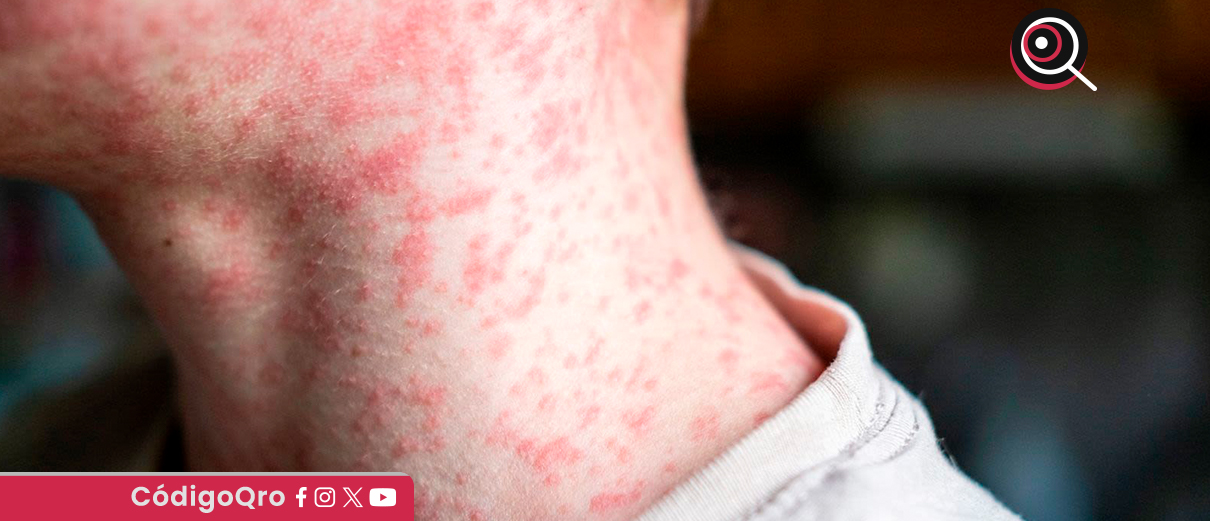 Suman más de 8 mil casos confirmados de sarampión en México