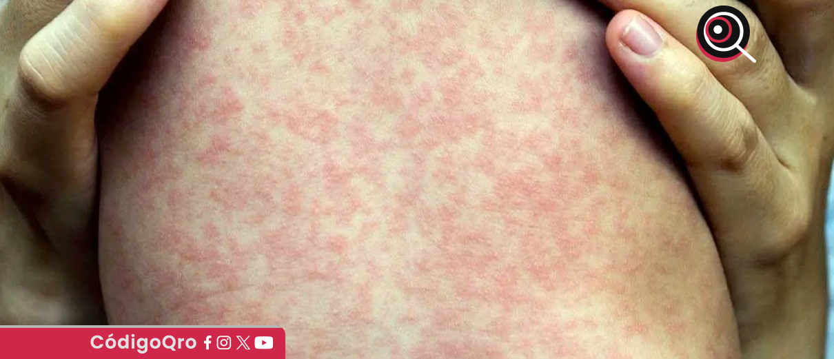 Ya son 14 casos confirmados de sarampión en Querétaro