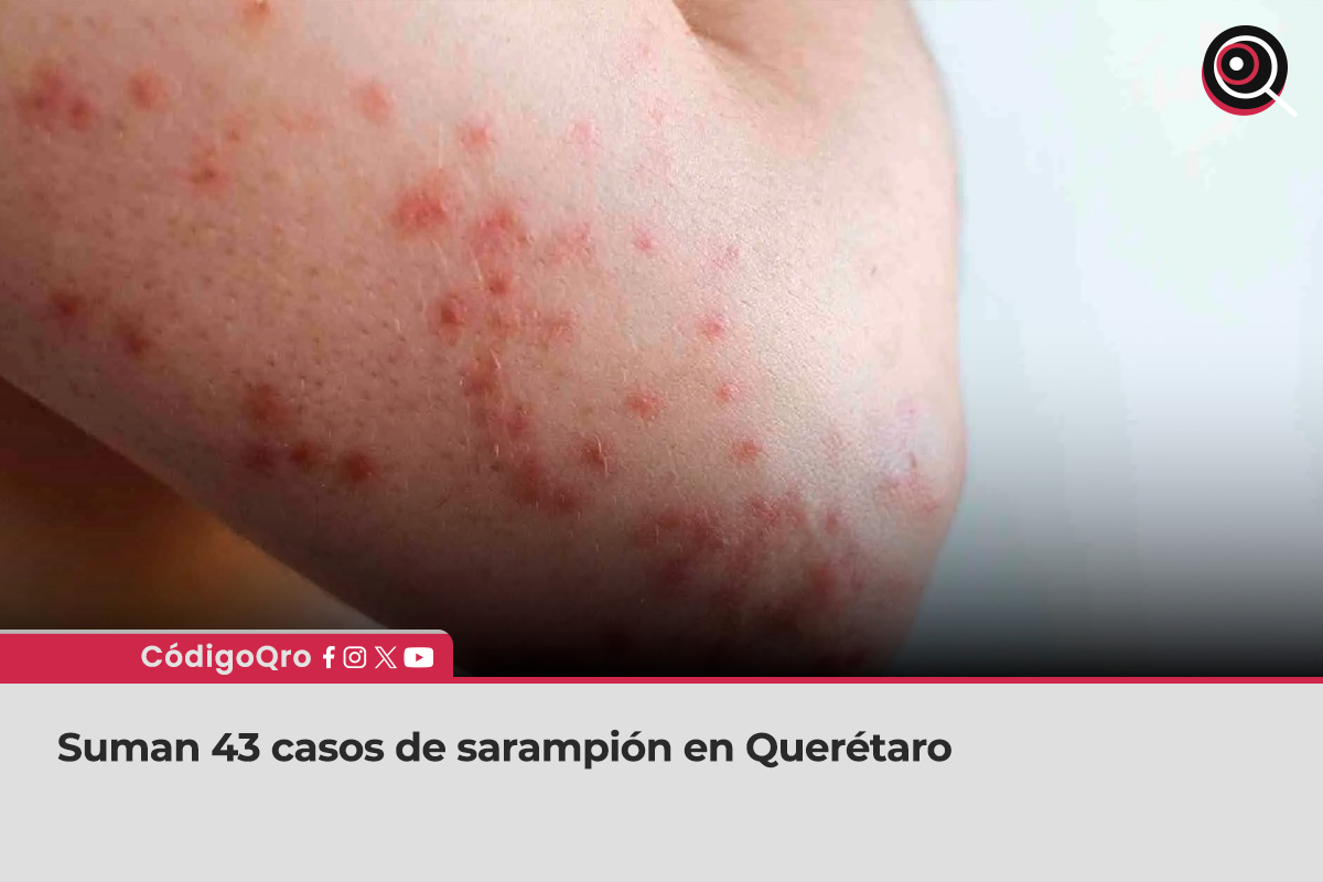 Suman 43 casos de sarampión en Querétaro