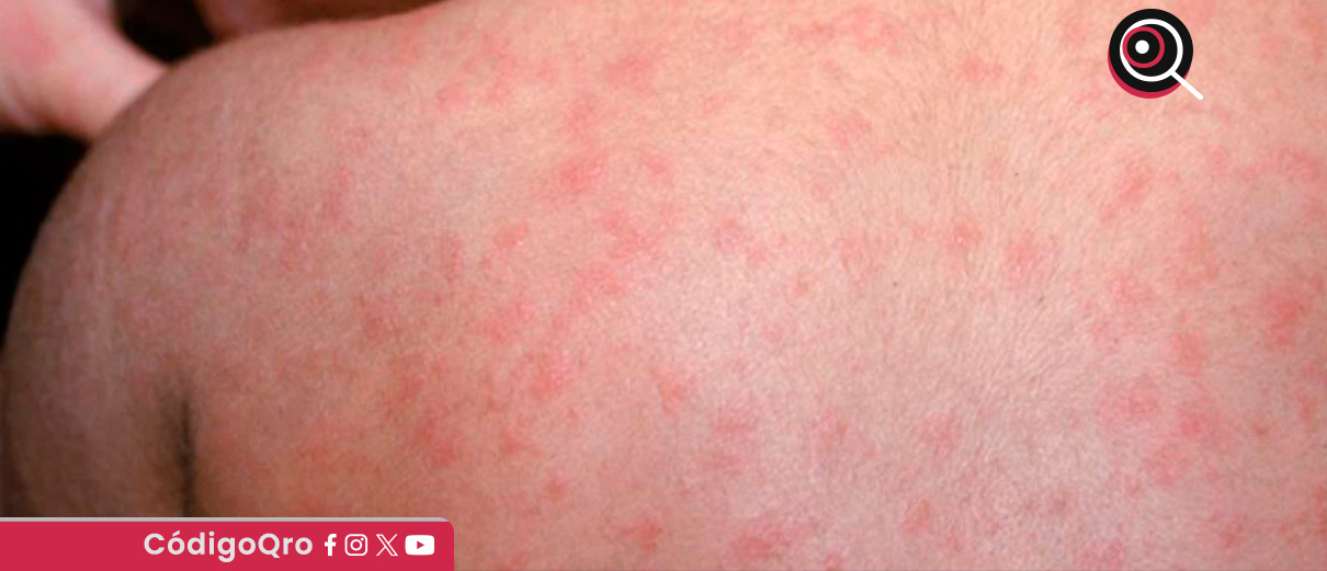 Reportan tres casos nuevos de sarampión en Querétaro