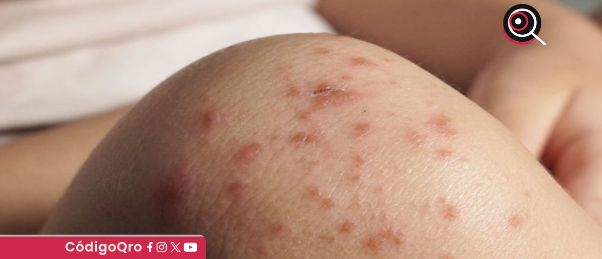 Detectan un caso de sarampión en el municipio de Querétaro